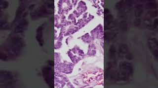 High Grade Serous Carcinoma of Ovary  Pathology shorts [upl. by Tiedeman789]