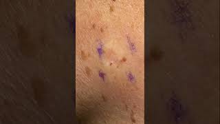 Age Spot Removal  Completely Gone [upl. by Ayadahs]