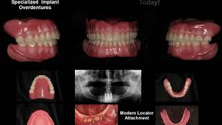 Old School to New School Implant Overdenture [upl. by Anileve402]