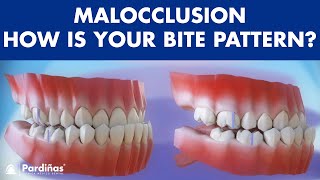 Malocclusion  Bite patterns © [upl. by Hewett]