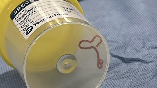 Neurosurgeon plucks worm from womans brain in Australia [upl. by Pierce775]