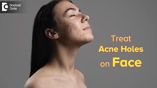 Top Ways to Get Rid of ACNE HOLES  How to fill ACNE HOLES on faceDr Rasya Dixit Doctors Circle [upl. by Clementas]