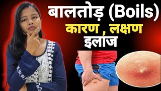 Baltod karan  Lakshan Or Ilaz  Best Treatment For Boils [upl. by Llesirg]