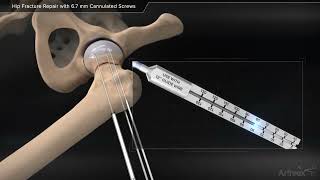 Hip Fracture Repair with Cannulated Screws [upl. by Anoik]