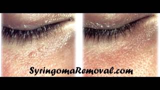 Syringoma removal cryotherapy [upl. by Zantos]