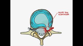 Epidural Steroid Injections What Your Surgeon Wants You to Know [upl. by Giardap510]