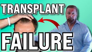 Why your Hair Transplant Surgery Failed [upl. by Em]