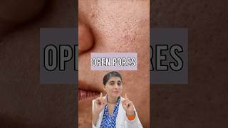 Open Pores  How to get rid of pores on face  Large pores treatment shorts [upl. by Llehcear]