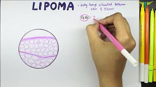 Lipoma Histopathology  Benign Mesenchymal tumor Histopathology  Gross  Microscopy [upl. by Isia]