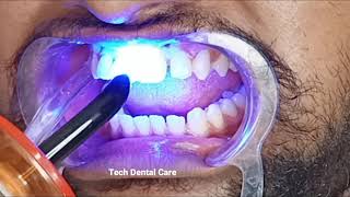 Teeth Gap Close Diastema closer treatment time lapse [upl. by Mowbray]