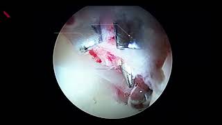 Surgical Technique  Puncture Capsulotomy Technique During Hip Arthroscopy [upl. by Eceirtal]