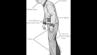 Extrapyramidal Symptoms [upl. by Lai]