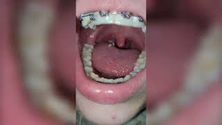 Deep Tonsil Stone Removal  Tonsil Stones [upl. by Vial248]