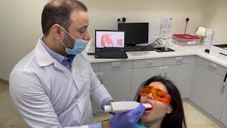 Dental digital impression dental scanning by 3shape for clear aligner putting the attachment on [upl. by Carl]