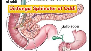 Disfungsi Sphincter of Oddi [upl. by Eicyaj422]