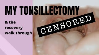 MY TONSILLECTOMY Daybyday recovery walkthrough [upl. by Evante]