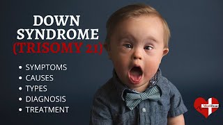 What is Down Syndrome Trisomy 21 Down syndrome Trisomy 21 Made Easy [upl. by Caneghem]