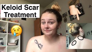 Keloid Scar Treatment baking soda method [upl. by Alit]