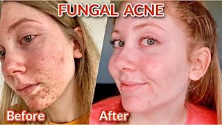 The Best Fungal Acne Treatments Of 2024 [upl. by Salisbury]