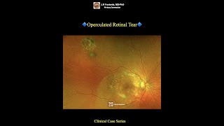 Operculated Retinal Tear [upl. by Salvidor462]