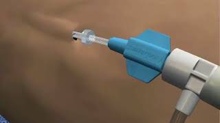 Laser for Veins  Endovenous Laser Ablation  AngioDynamics NeverTouchR Venacure EVLTTM [upl. by Varden]