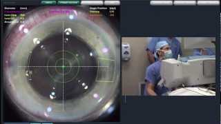 Dr Scott Perkins Performs a LenSx ProcedureBarnet Dulaney Perkins Eye Center AZ [upl. by Grenier424]