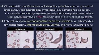 Hemolytic Uremic Syndrome HUS [upl. by Holder792]