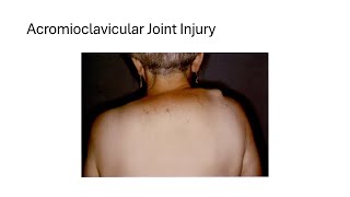 Acromioclavicular Joint Injury [upl. by Chip446]