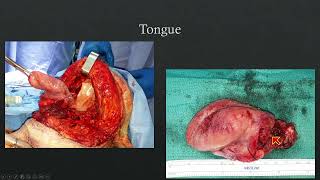 2023  Surgical Approaches to the Oral Cavity amp Oropharynx  Michael Sim [upl. by Ertemed341]