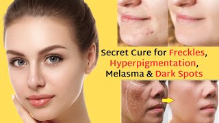 secret cure for freckles hyperpigmentation melasma amp dark spots heres the 100 solution [upl. by Gayleen653]