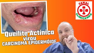 Queilite Actínica que evoluiu para Carcinoma Epidermóide [upl. by Rivera]