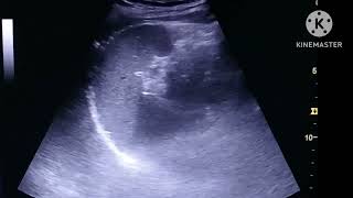 Ureteric stone on Ultrasound [upl. by Oetam224]