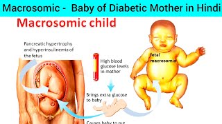 Baby of Diabetic Mother in Hindi  Macrosomic Baby Obstetrics  Large Baby Macrosomia  Macrosomia [upl. by Ecinev822]