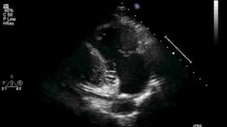 Transthoracic ECHO Parasternal Long RV Inflow View [upl. by Airdnaz]