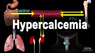 Hypercalcemia  Too Much Calcium Animation [upl. by Farwell795]