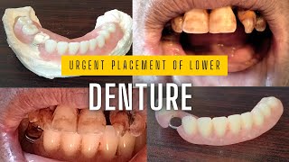 Removable lower partial denture urgent fitting  partial denture dentures missingtooth asmr [upl. by Littell]