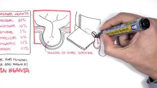 Introduction to Direct and Indirect Inguinal Hernia [upl. by Hansiain]