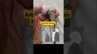 Artificial Ceramic Hip for Damaged Hip Joints🔥hipjointreplacement hipfracturerecovery [upl. by Gaskin]