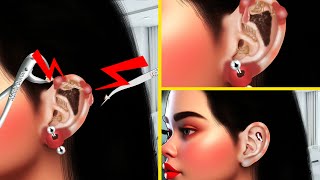 ASMR Infected Ear Piercing Treatment Animation  ASMR Ear Pus Removal Animation  ASMR Derm [upl. by Janene]