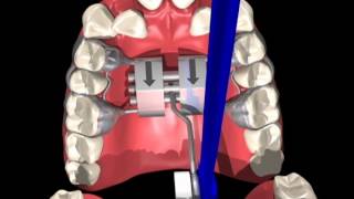 How to turn an RPE Appliance by Dr Enoch [upl. by Lentha350]