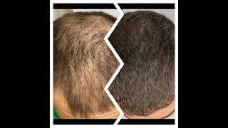 21 Month Finasteride13 Month Minoxidil2 Month Stemoxydine BeforeAfter [upl. by Allissa]