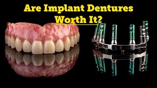 Denture FAQs  Types of Implant Dentures SnapOn Dentures [upl. by Surad344]