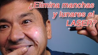 ¿Quita las Manchas y los Lunares el Láser [upl. by Taveda]