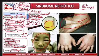 Qx nefrologia  SINDROME NEFROTICO [upl. by Saval149]