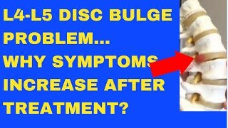 Why Does L4 L5 Disc Bulge Symptom Increase After Treatment  Answered by Chiropractor in Vaughan [upl. by Nonnair]