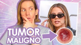 KHLOE KARDASHIAN tiene un TUMOR EN LA CARA  Todo sobre su tumor maligno  Simon Scarano Dermatologo [upl. by Ttihw]