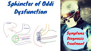 Sphincter of Oddi Dysfunction Made Easy to understand [upl. by Esyned]