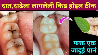 घरातील फक्त 2 वस्तू वापरा दातांन संबंधित सर्व समस्या दूर होतील😱 kitchen tips  teeth  home remedies [upl. by Nniroc477]