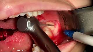 partially impacted lower wisdom tooth extraction [upl. by Ahtiuqal]