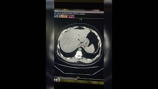 CT Scan of Abdominal [upl. by Theadora]